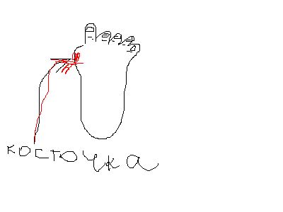 Девочки, интимный вопрос Очень болит косточка, ну которая на ступне, блин